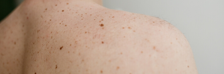 Skin Cancer Prevention: Importance of Regular Skin Checks - 2