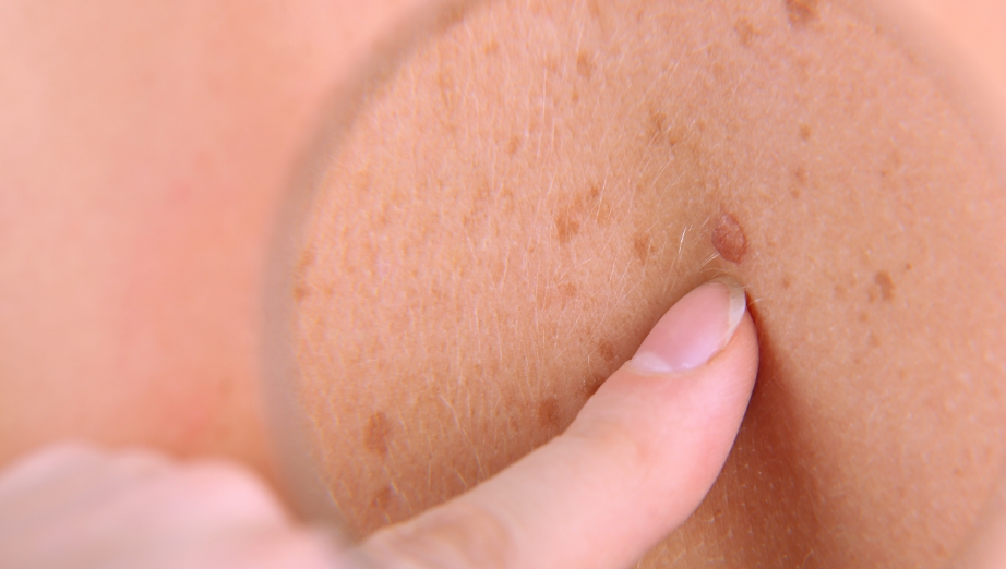 Topical-Skin-cancer