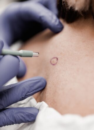 Skin Cancer Surgery